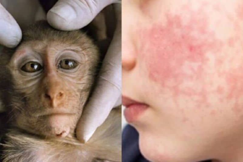 Viruela de mono, el virus que inquieta al mundo aún no tiene casos en el país