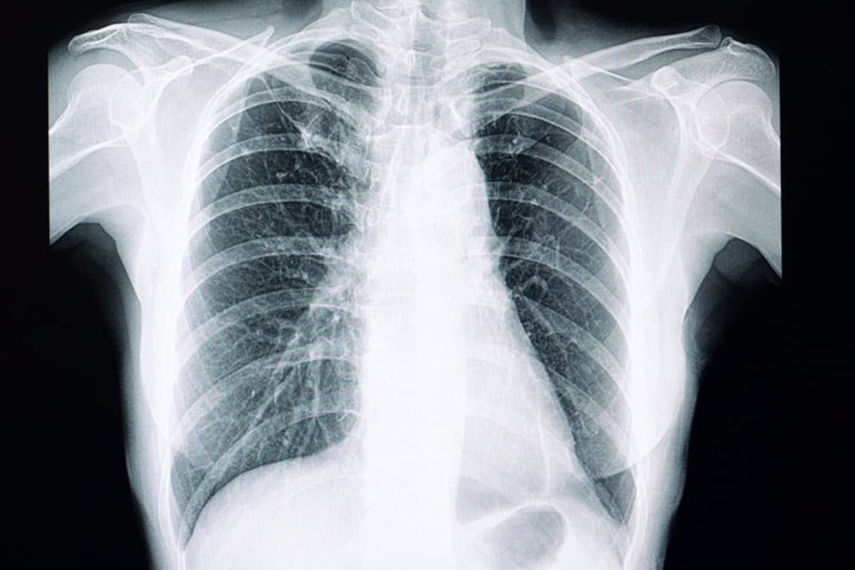 Cáncer de pulmón. La principal estrategia para evitar el tumor maligno que más vidas se lleva por año en el mundo