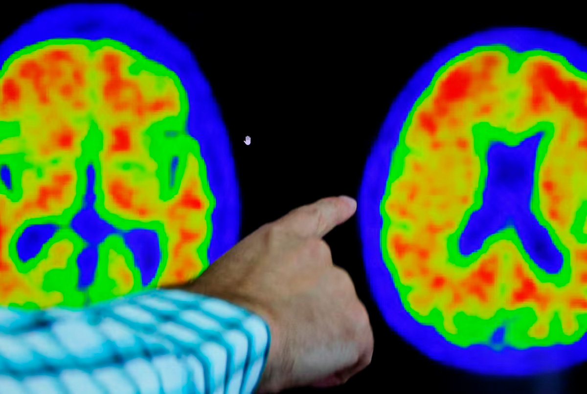 Crean un gran mapa molecular para entender el Alzheimer