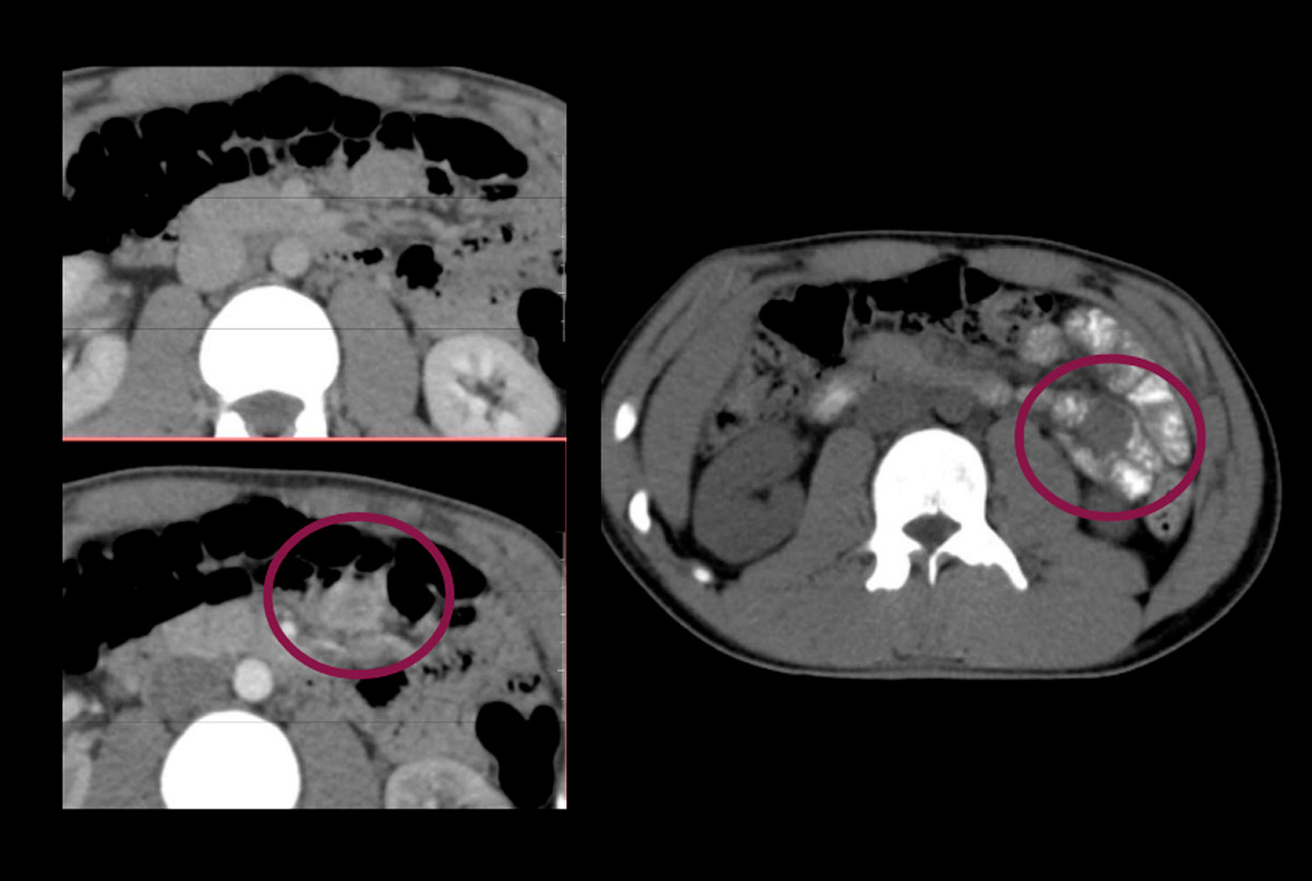 Hemorragia digestiva en paciente joven