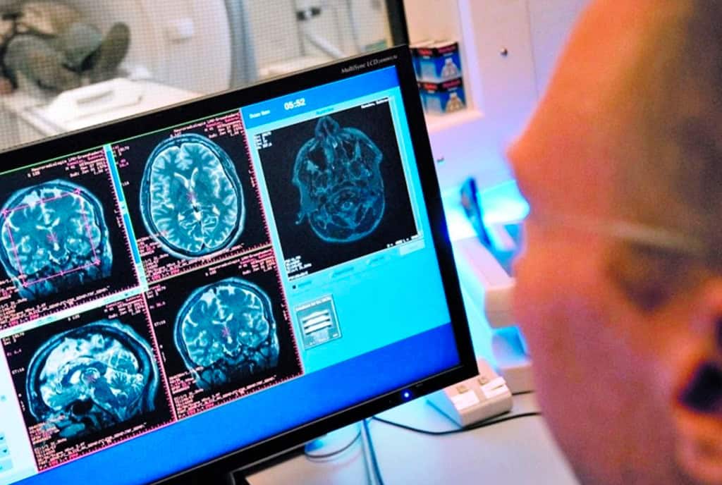 Científicos descubren el mecanismo de las células tumorales para alterar el cerebro y lograr diseminar el cáncer